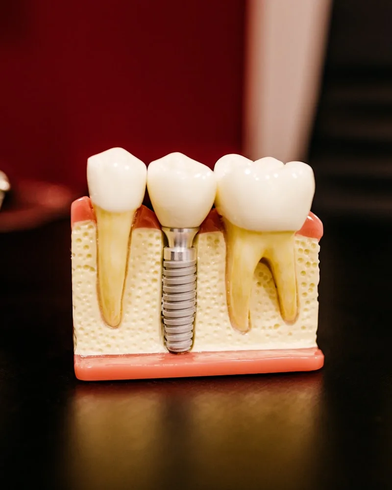 Implantes e próteses