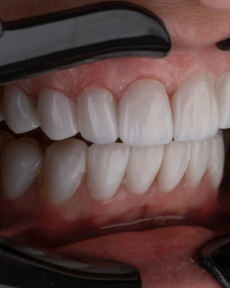 Prótese fixa sobre implantes